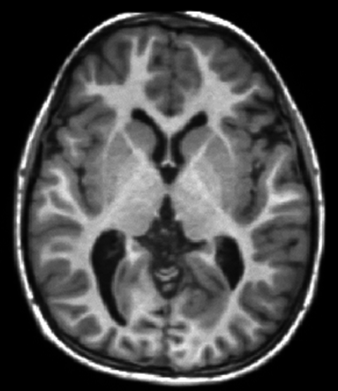 T1-weighted-MRI